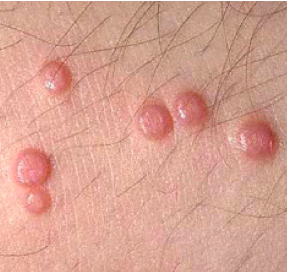 <span style="font-weight: bold;">        MOLUSCO           CONTAGIOSO</span>