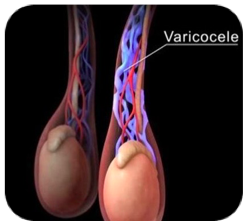 <span style="font-weight: bold;">     VARICOCELE</span>