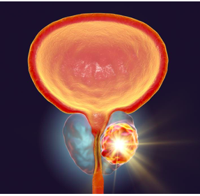      CÁNCER DE              PRÓSTATA 