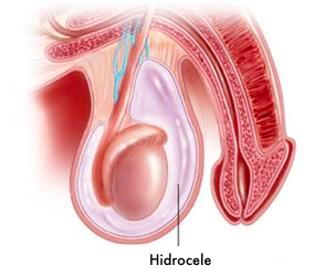 <span style="font-weight: bold;">      HIDROCELE</span>