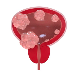       CÁNCER DE                 VEJIGA 