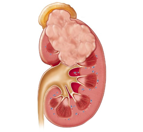  CÁNCER RENAL 